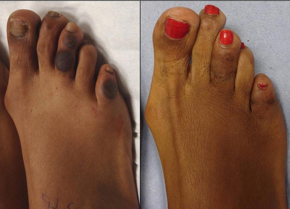 Healed foot following lump removal